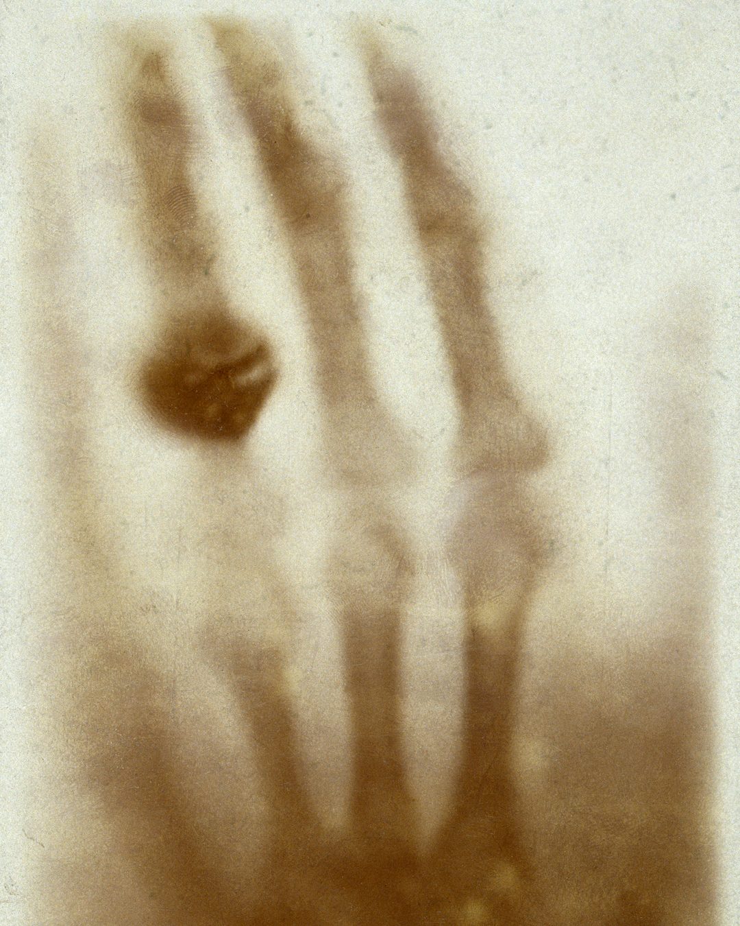 Radiografia da mão de Anna Bertha Röntgen, feita por Wilhelm Röntgen em dezembro de 1895; não é uma radiografia de Coimbra. (Wikimedia Commons, domínio público)